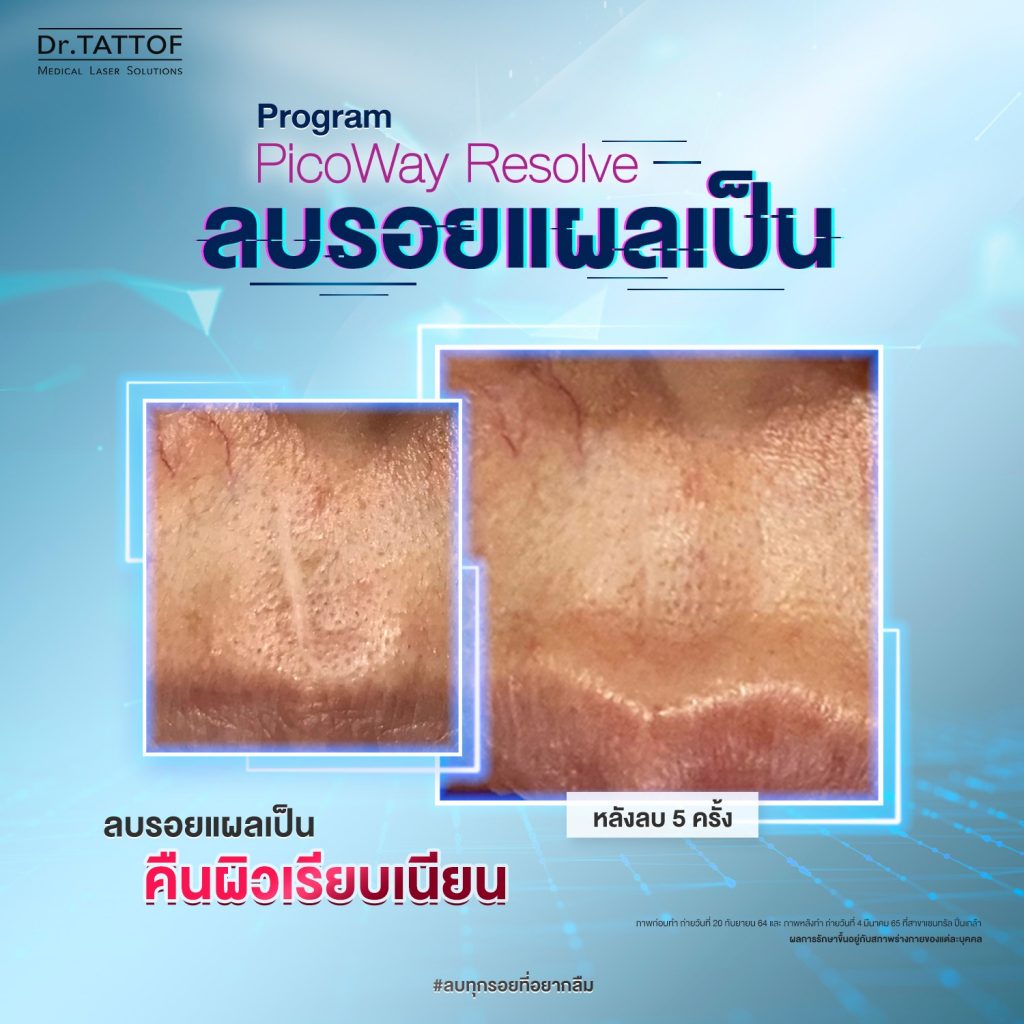 ลบรอยแผลเป็น