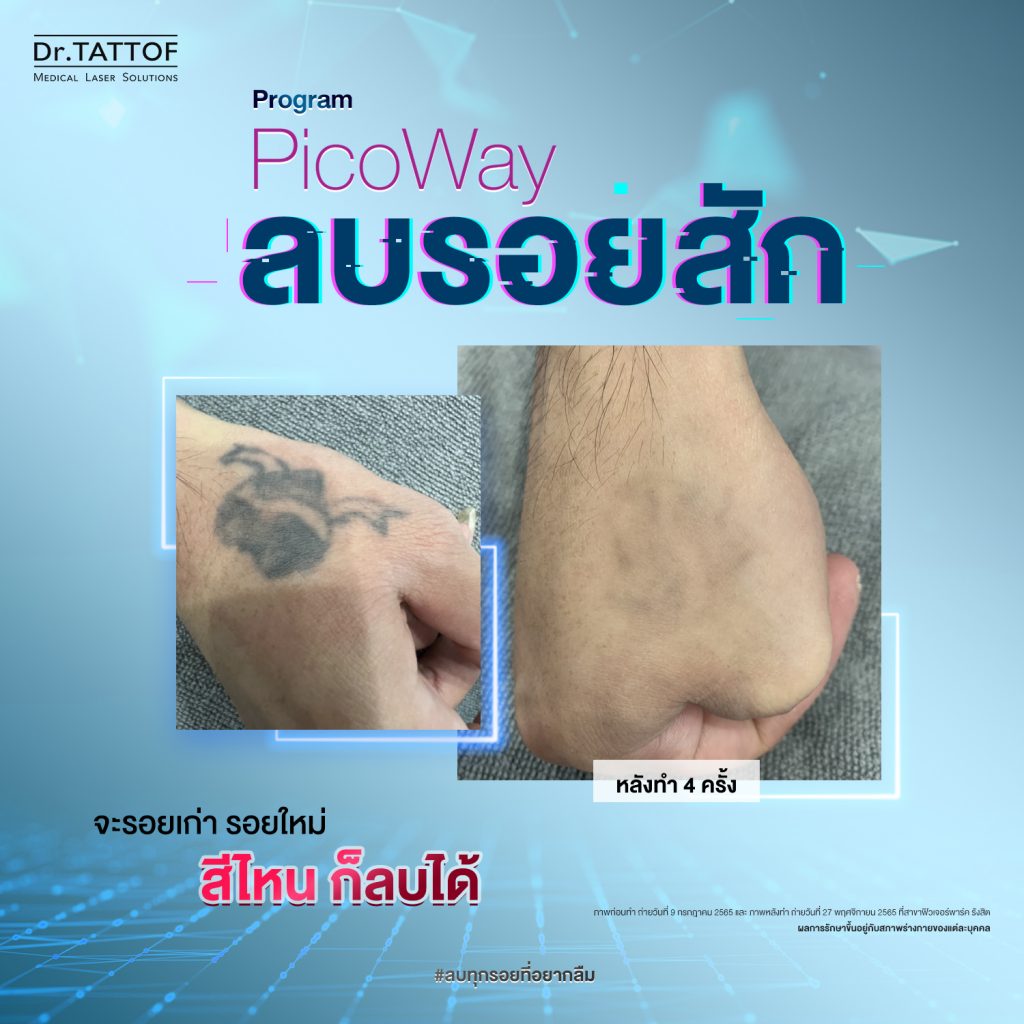 ลบรอยสัก