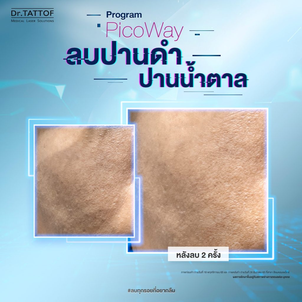 ลบปาน