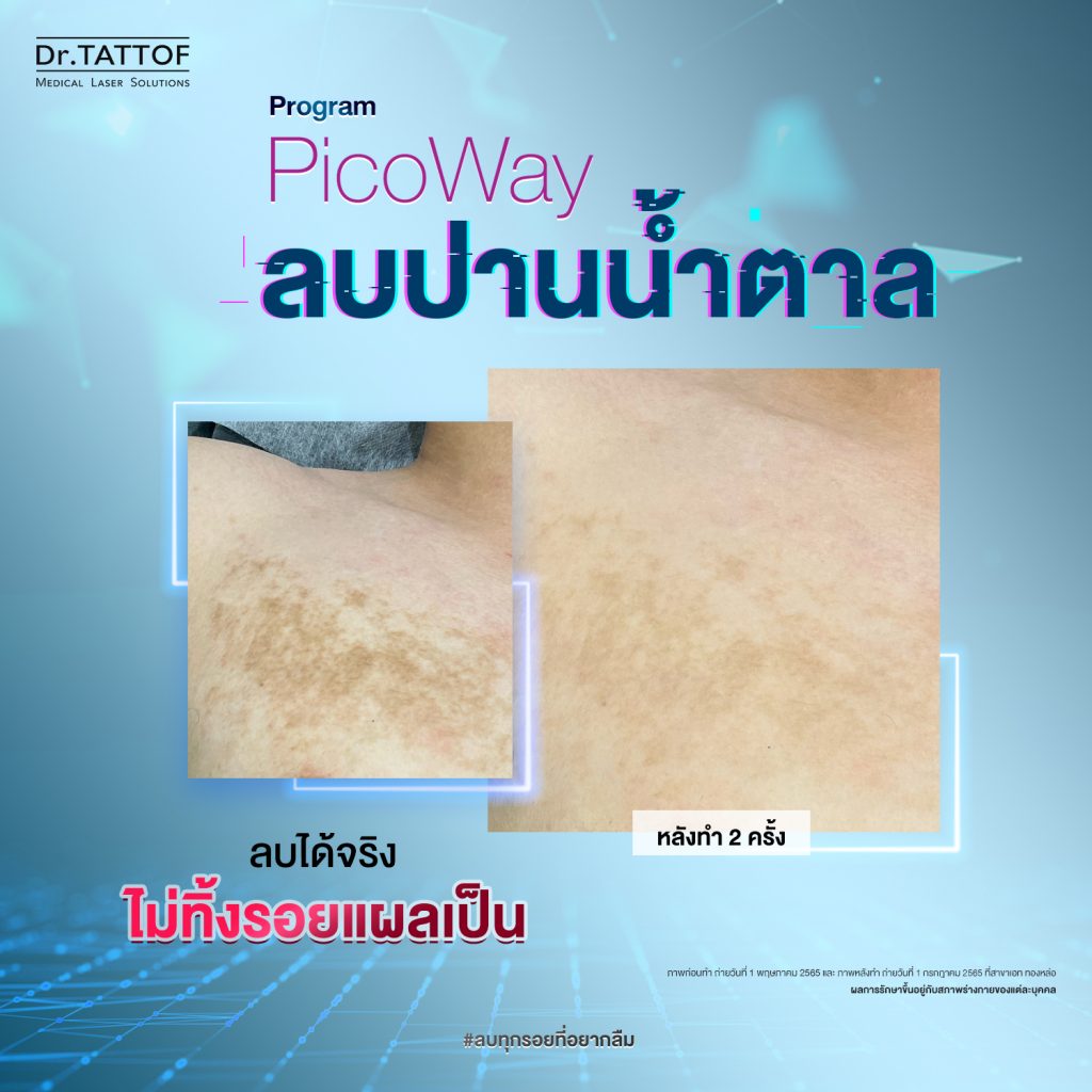 ลบปาน