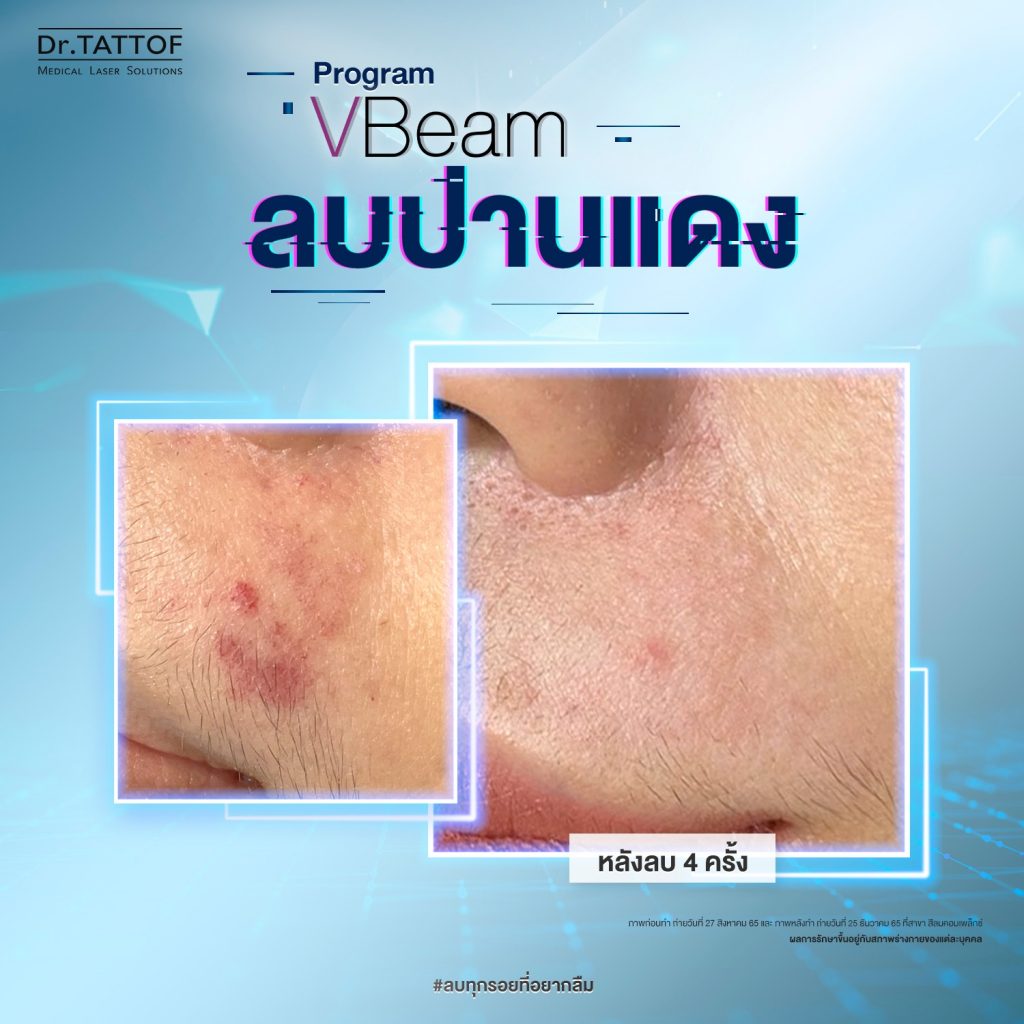 ลบปาน