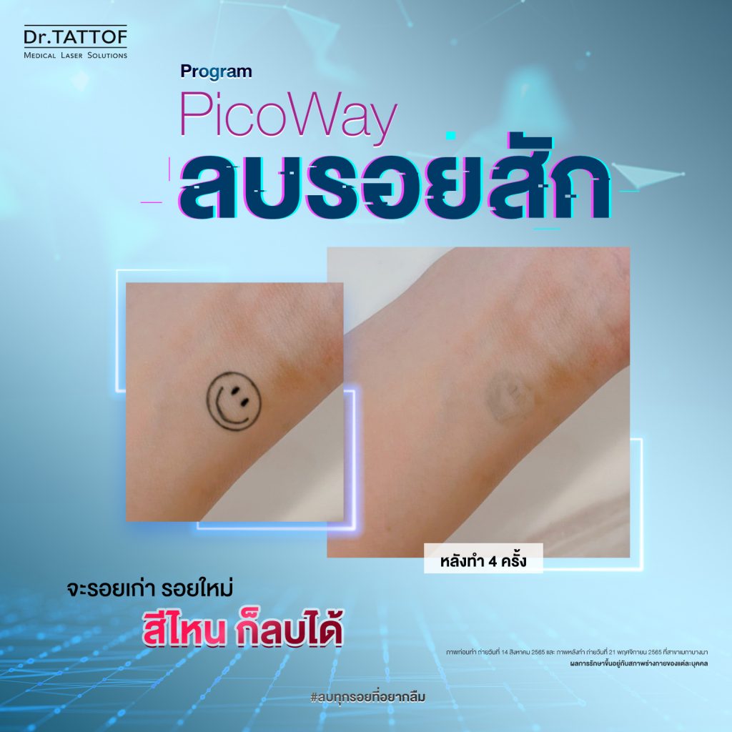 ลบรอยสัก