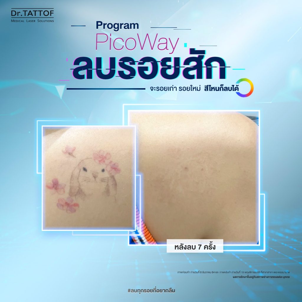 ลบรอยสัก