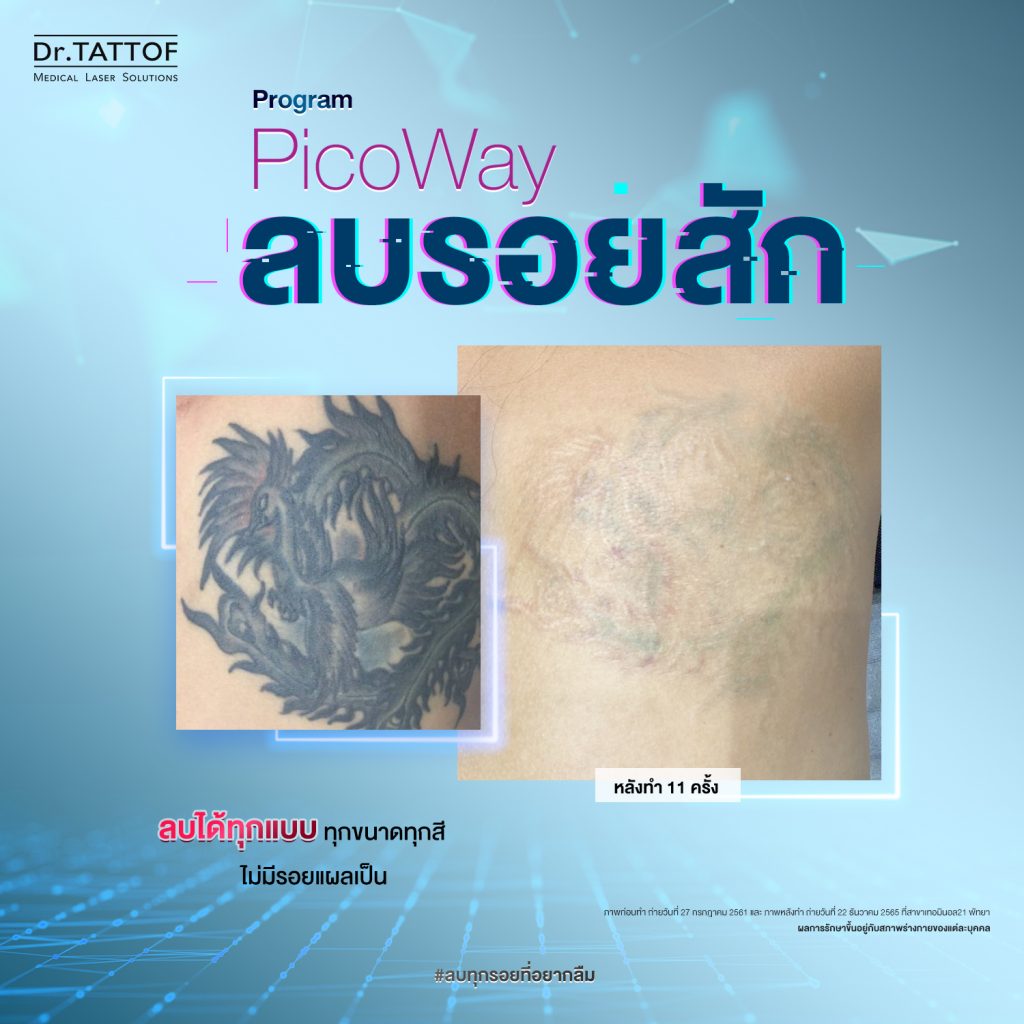 ลบรอยสัก